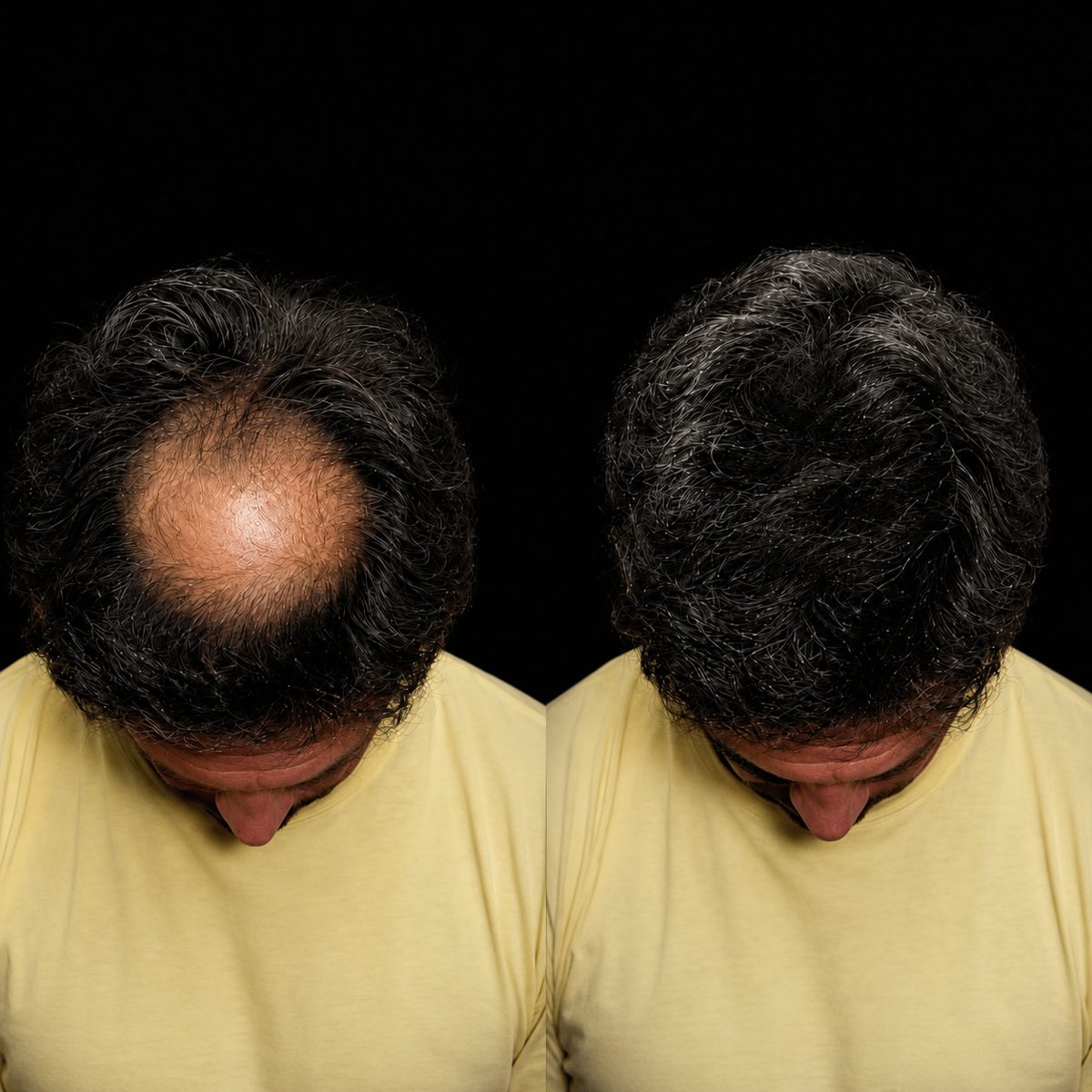 Densification et pigmentation — avant / après