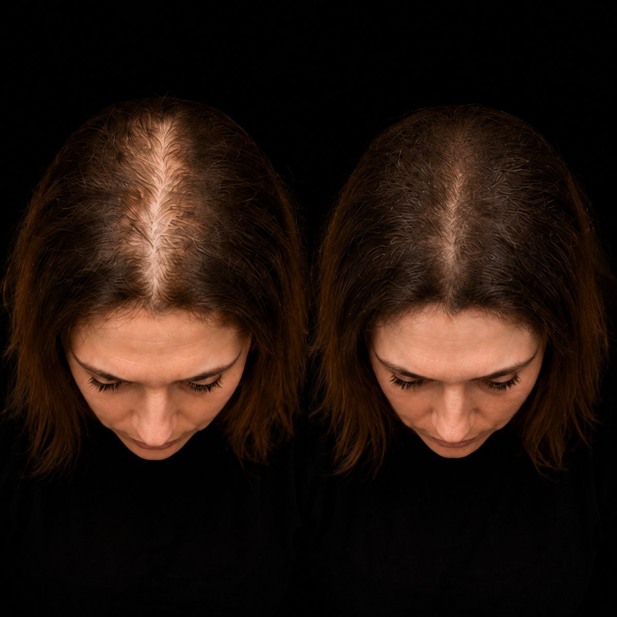Densité femme — effluvium télogène, avant / après