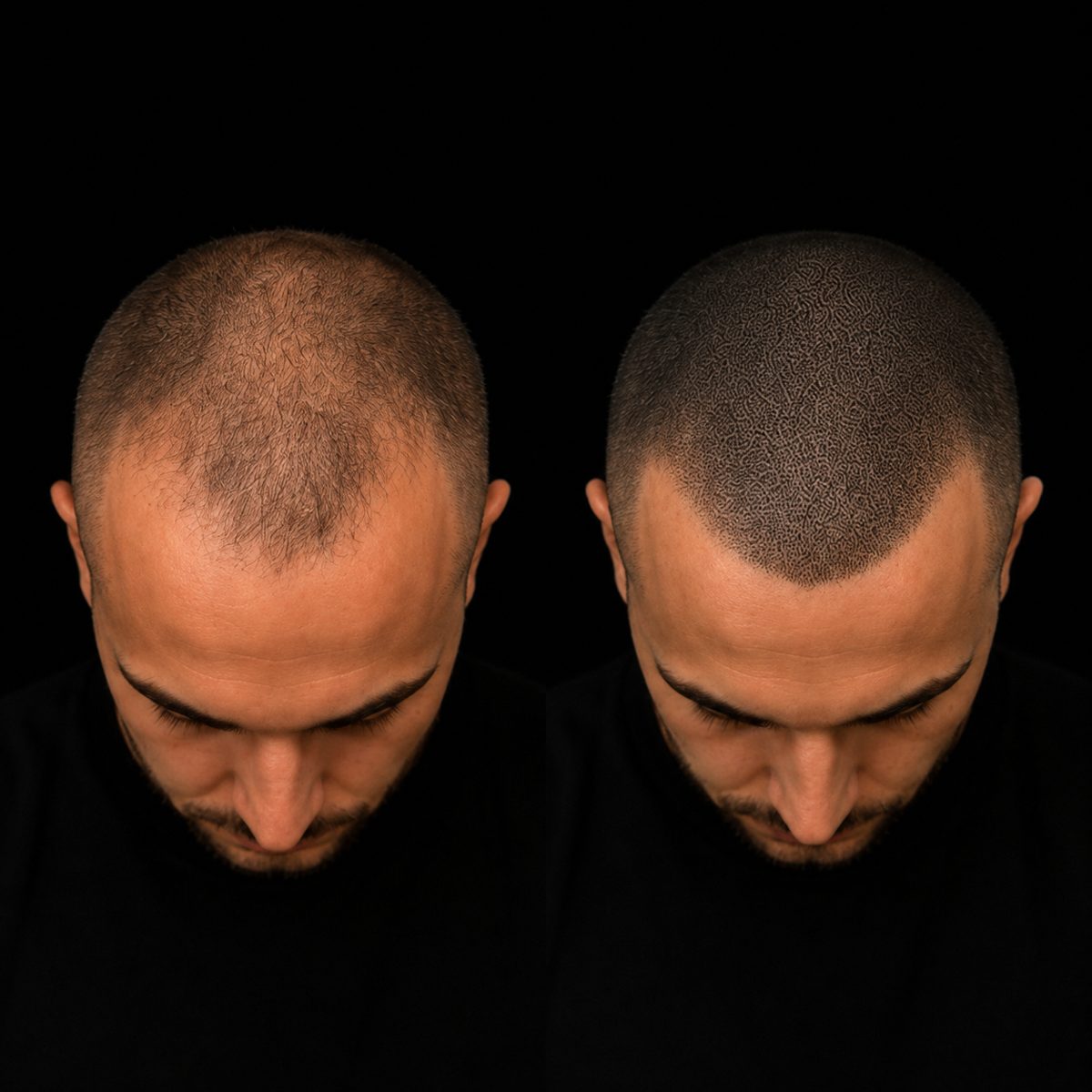 Effet naturel indétectable — avant / après